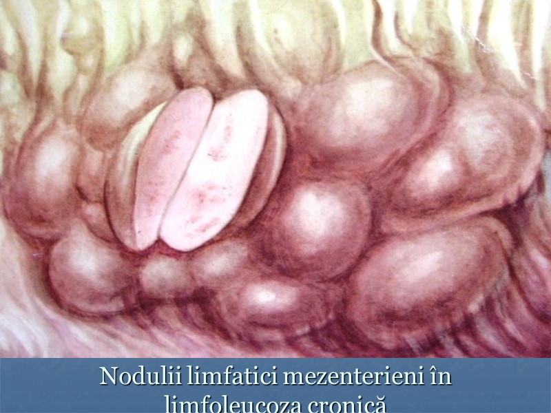 Nodulii limfatici mezenterieni în limfoleucoza cronică